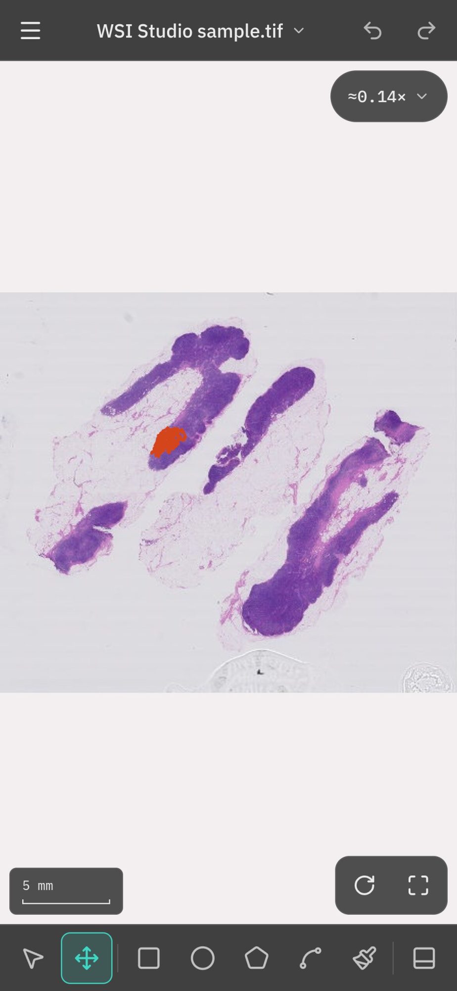 WSI Studio on a phone with the sample lymph node slide open, a tumour region outlined in red, a scale bar and the touch toolbar along the bottom